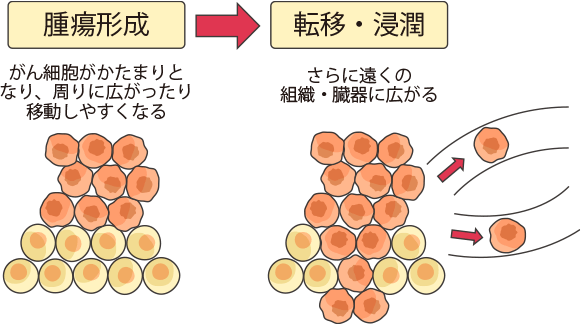 悪性腫瘍と良性腫瘍の違い