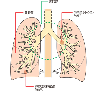 肺門型肺がんと肺野型肺がん