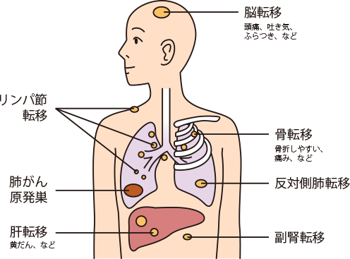 右腕 の 痛み 肺がん