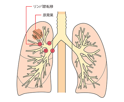 限局型小細胞肺がんの病変の範囲