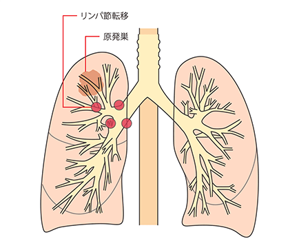 肺がんを知るまとめ | 肺がんを知る | 肺がんとともに生きる