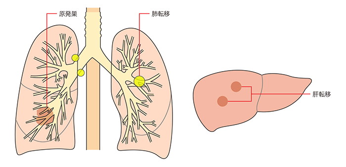 進展型小細胞肺がんの病変の範囲