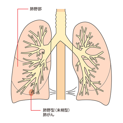 大細胞がんの発生しやすい場所