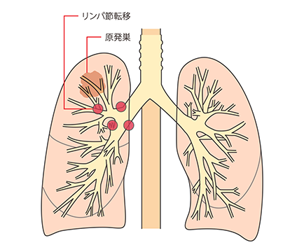 小細胞肺がんとは 肺がんの種類 4つのタイプに分けられる肺がん 肺がんとともに生きる