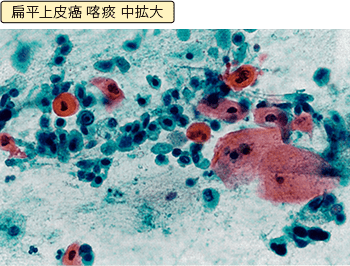 痰に混じったがん細胞を見つけ出す 肺がん検査のさまざまな方法 肺がんとともに生きる