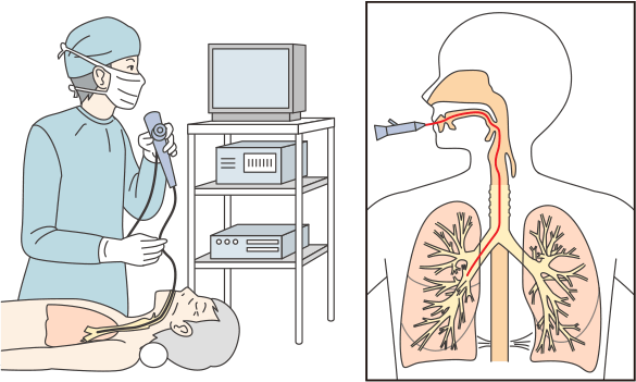 気管支を観察する気管支内視鏡