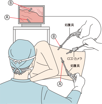 胸腔鏡