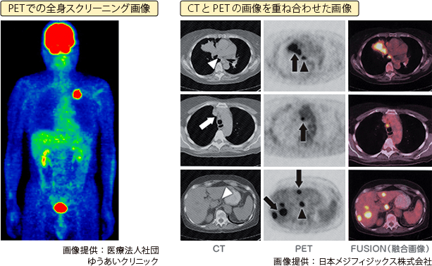 PETでの全身スクリーニング画像