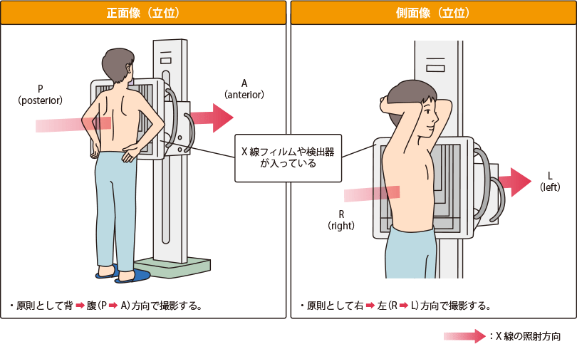 肺がんのレントゲン X線 検査 肺がん検査のさまざまな方法 肺がんとともに生きる