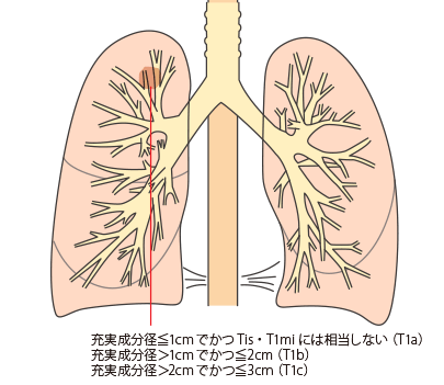 T1a・T1b・T1c