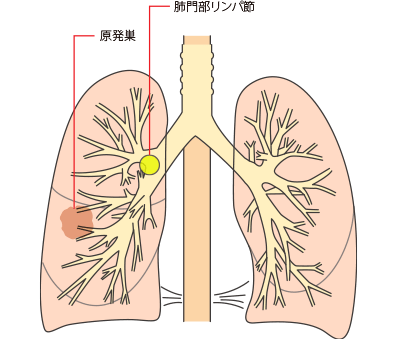 IIA，IIB期