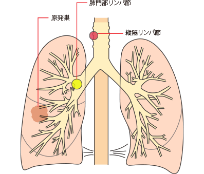 IIIA期