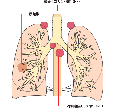 IIIB期