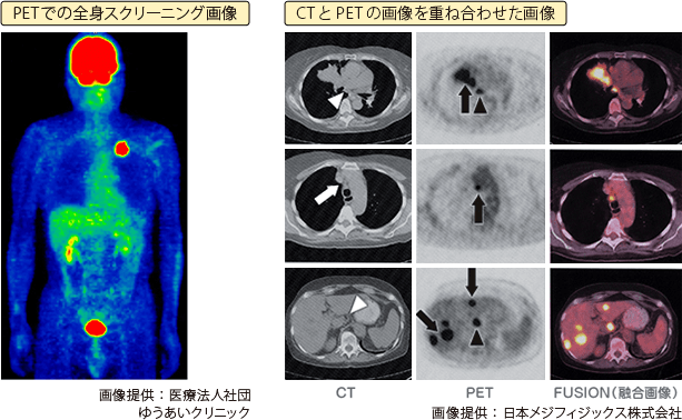 がんの転移を調べるPET検査