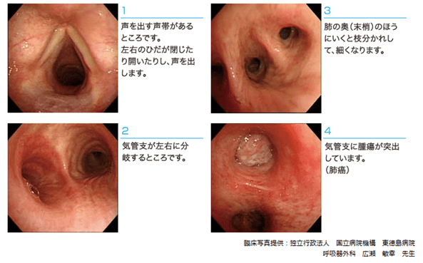 気管支鏡の観察写真
