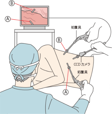 手術も可能な胸腔鏡