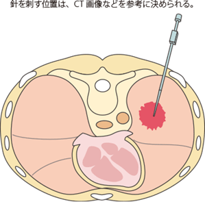 経皮肺生検