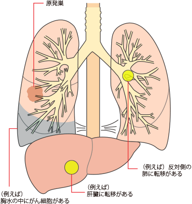 性 肺癌 原発