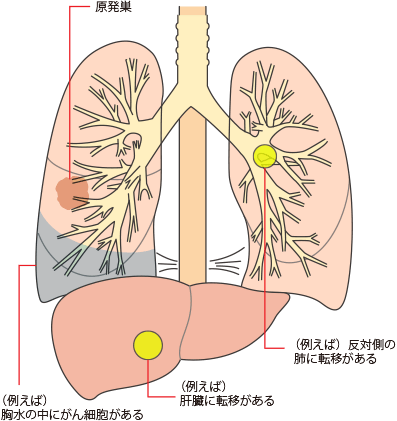 肺 に 水 が 溜まる 病気