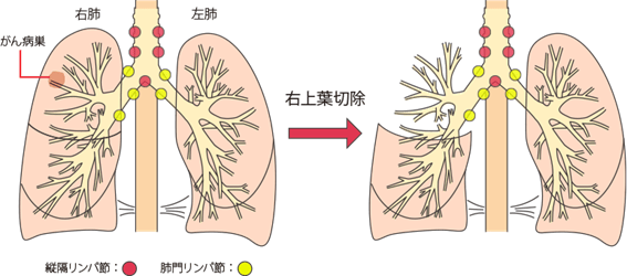 標準的な手術：肺の房（肺葉）を切り離す