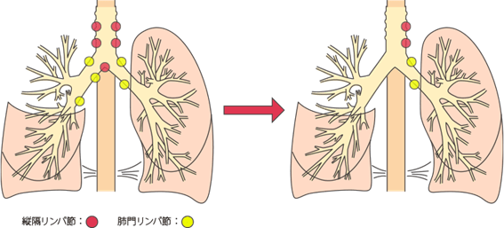 リンパ節の郭清：がん細胞を残さないためにリンパ節をとる