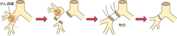 気管支形成術：できるだけ肺を残すために気管支をつなげる