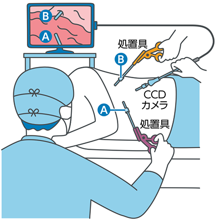 胸腔鏡（内視鏡）手術とは？ 