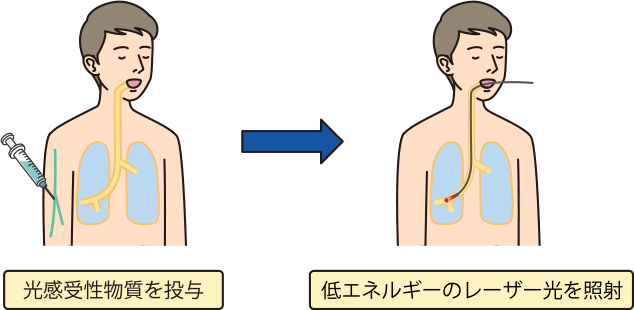 光線力学的治療法