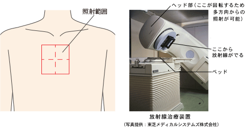 放射線治療装置と照射範囲
