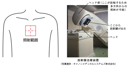 手術後に化学療法（抗がん剤）をおこなう理由