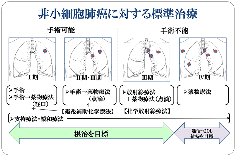 非小細胞肺癌に対する標準治療
