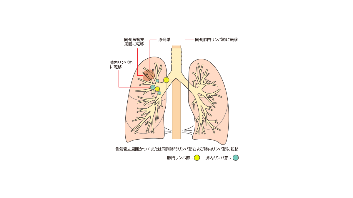 N リンパ節の転移は 肺がんのステージ 病期 Tnmってなに 肺がんとともに生きる