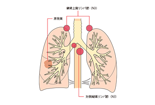 Iv期 ステージ4 の肺がん 転移性肺がん Tnmで病期は決まる 肺がんとともに生きる